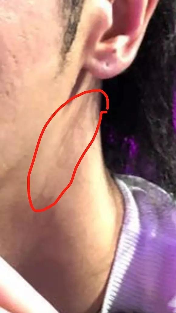 华晨宇削下颌骨的后果,华晨宇下颌骨内推