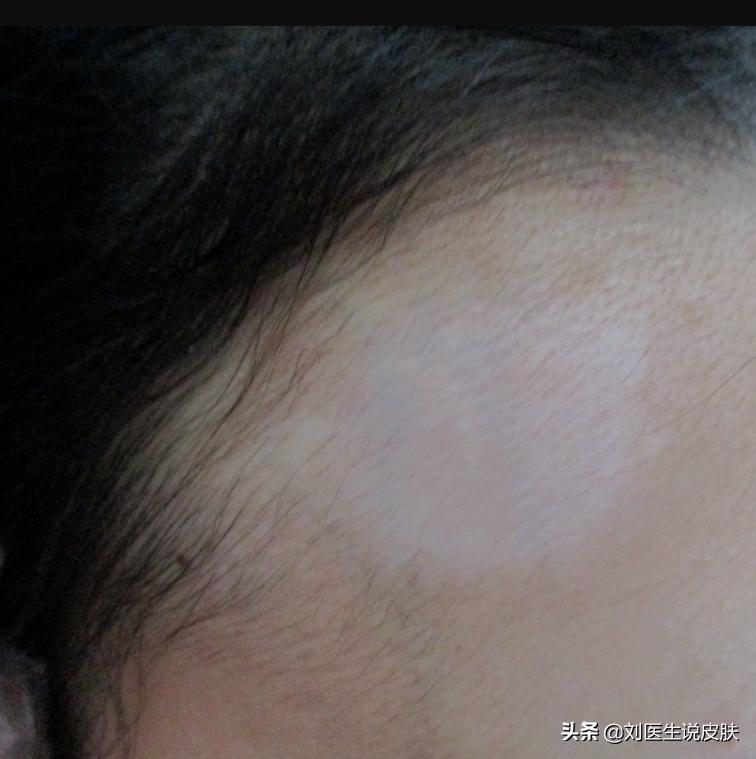 额头白斑，生姜涂擦后扩散怎么办？医生1个方案，治白又快又好