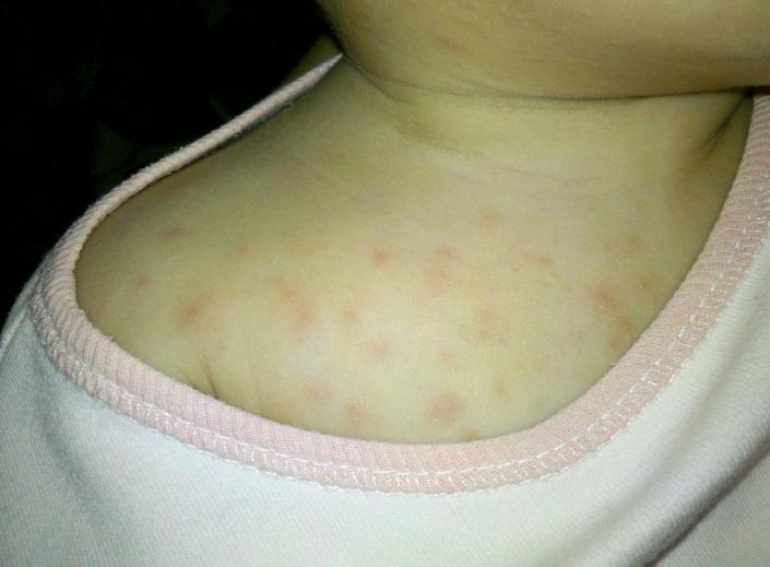 医学科普湿疹做好这几点减少复发,谈谈湿疹的中医药防治与调养