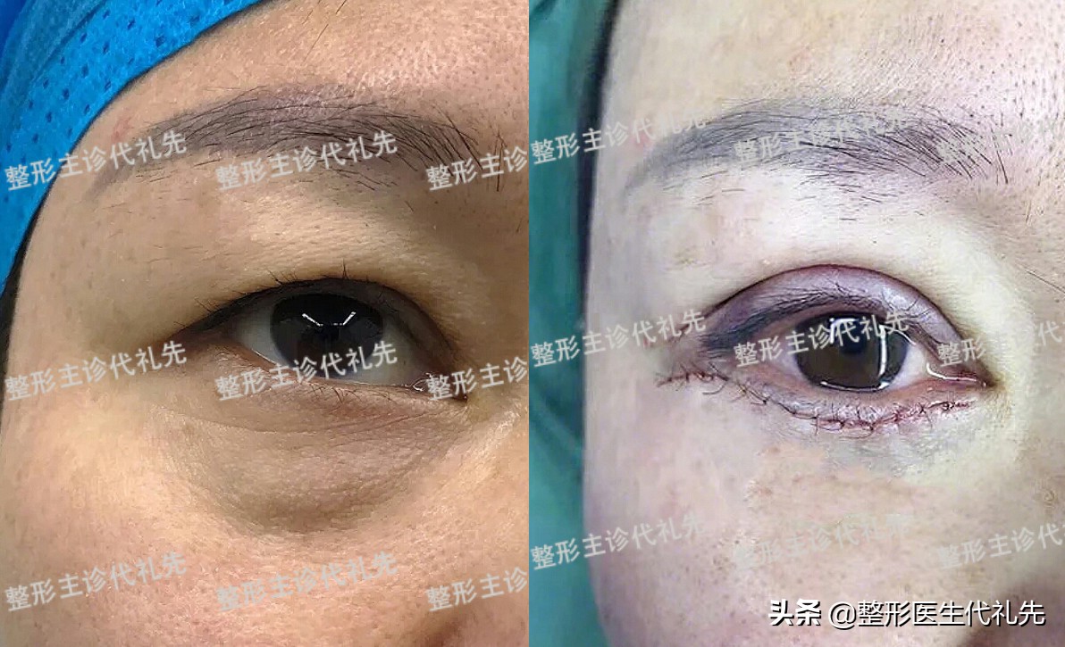 下眼袋下边的皱纹叫什么,下眼袋有皱纹图片