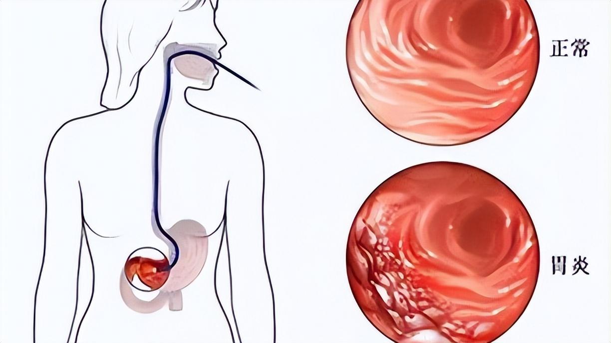 胃炎三分治七分养，医生直言：胃炎患者改善饮食才是最大的良药