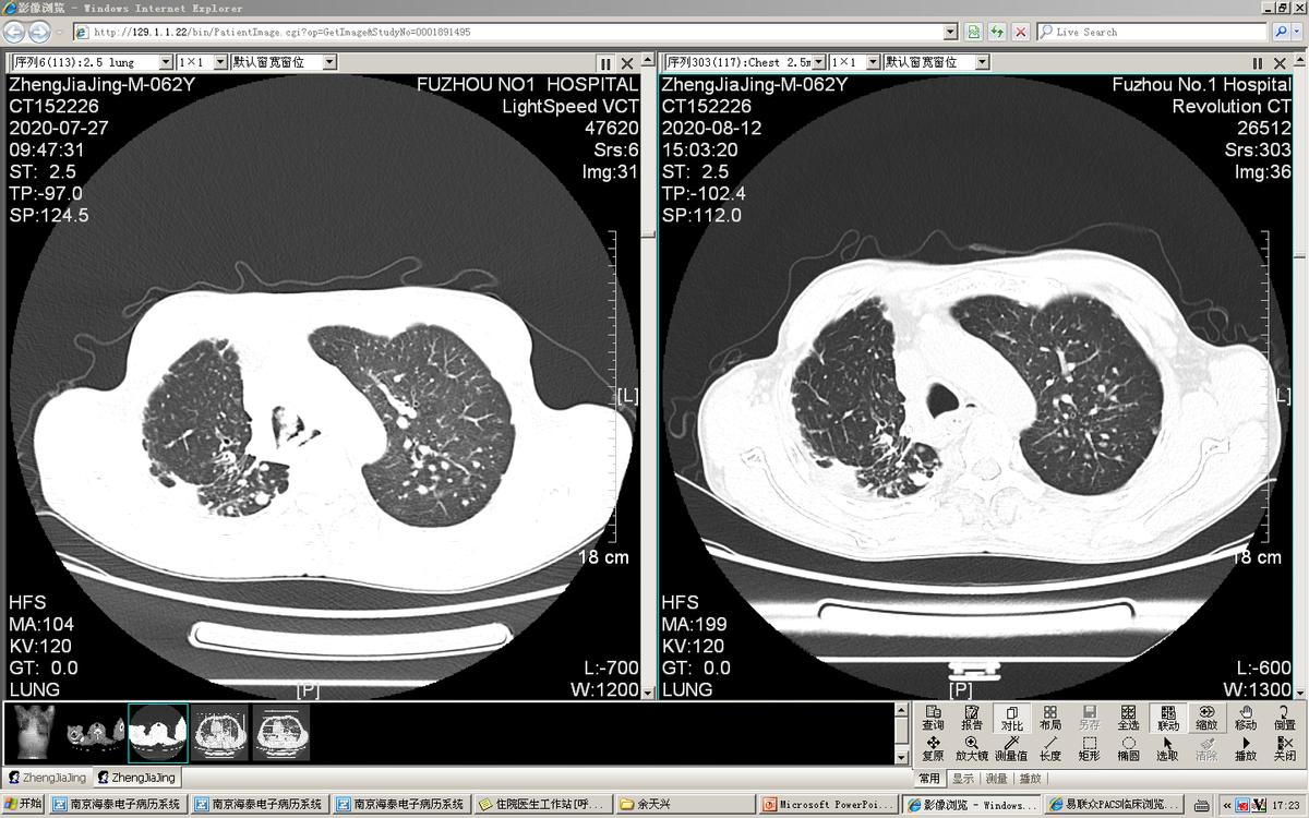 气管镜下肿瘤怎么治疗,气管肿物是什么