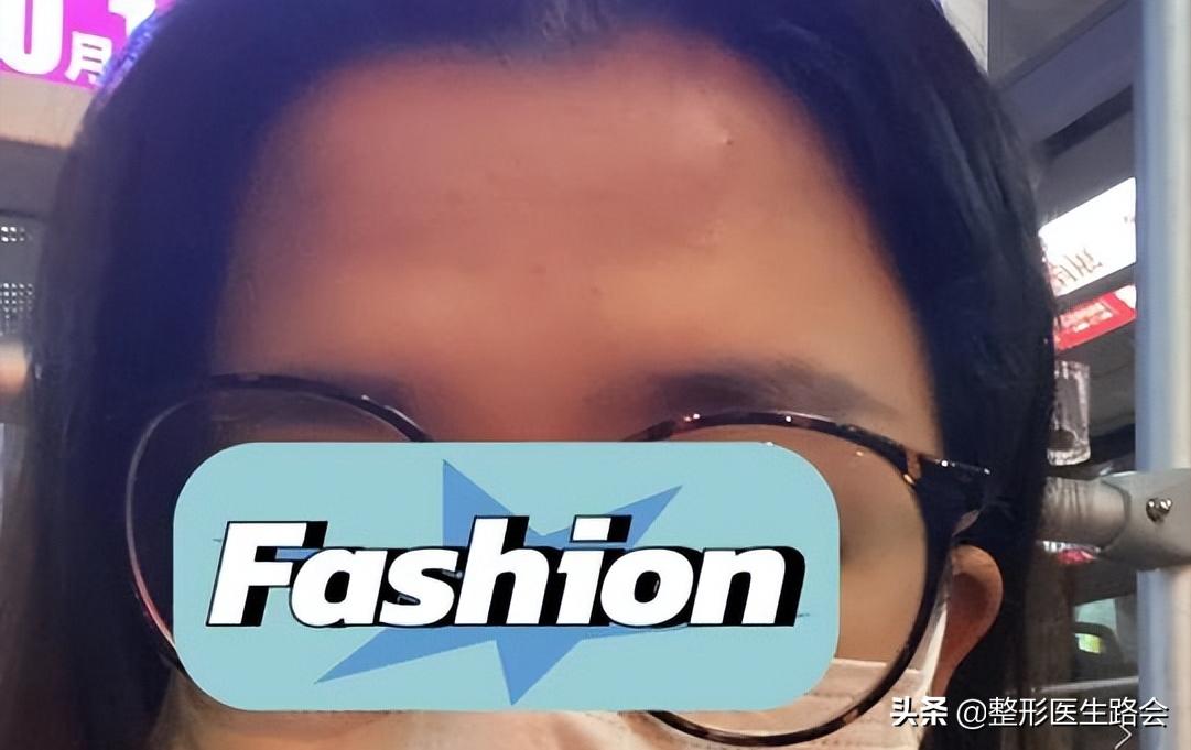 填充额头为什么额头有坑,填充额头过度饱满怎么消除