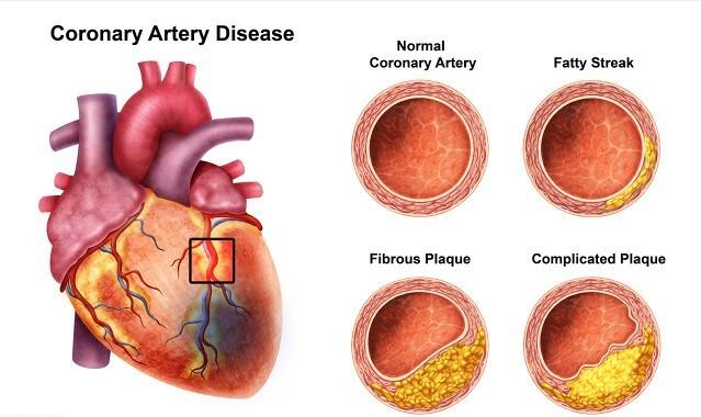 抗动脉粥样硬化最新药物,抗氧化预防动脉粥样硬化的药物是