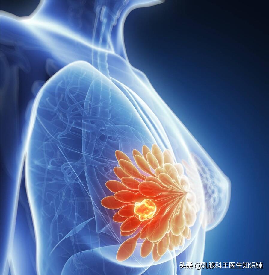 乳头出现溢液你需要进行这些检查、治疗和预防(下)