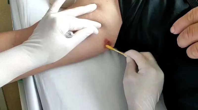 有一个眼皮子发肿是什么原因,莫名其妙的一个眼皮肿了怎么回事