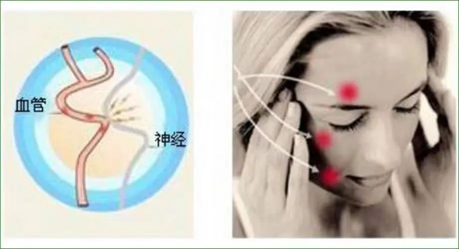 脸上像触电瞬间麻一下,脸上像针扎一样疼怎么回事