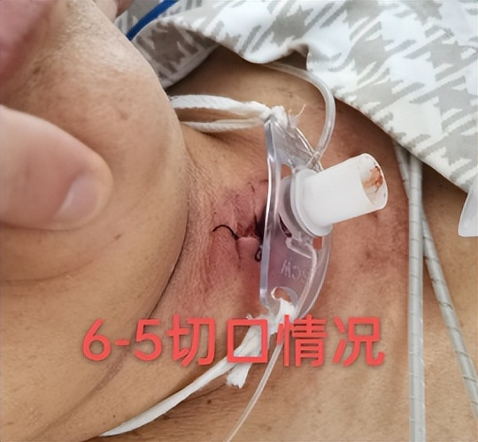 切口皮肤红肿,气切切口红肿怎么处理