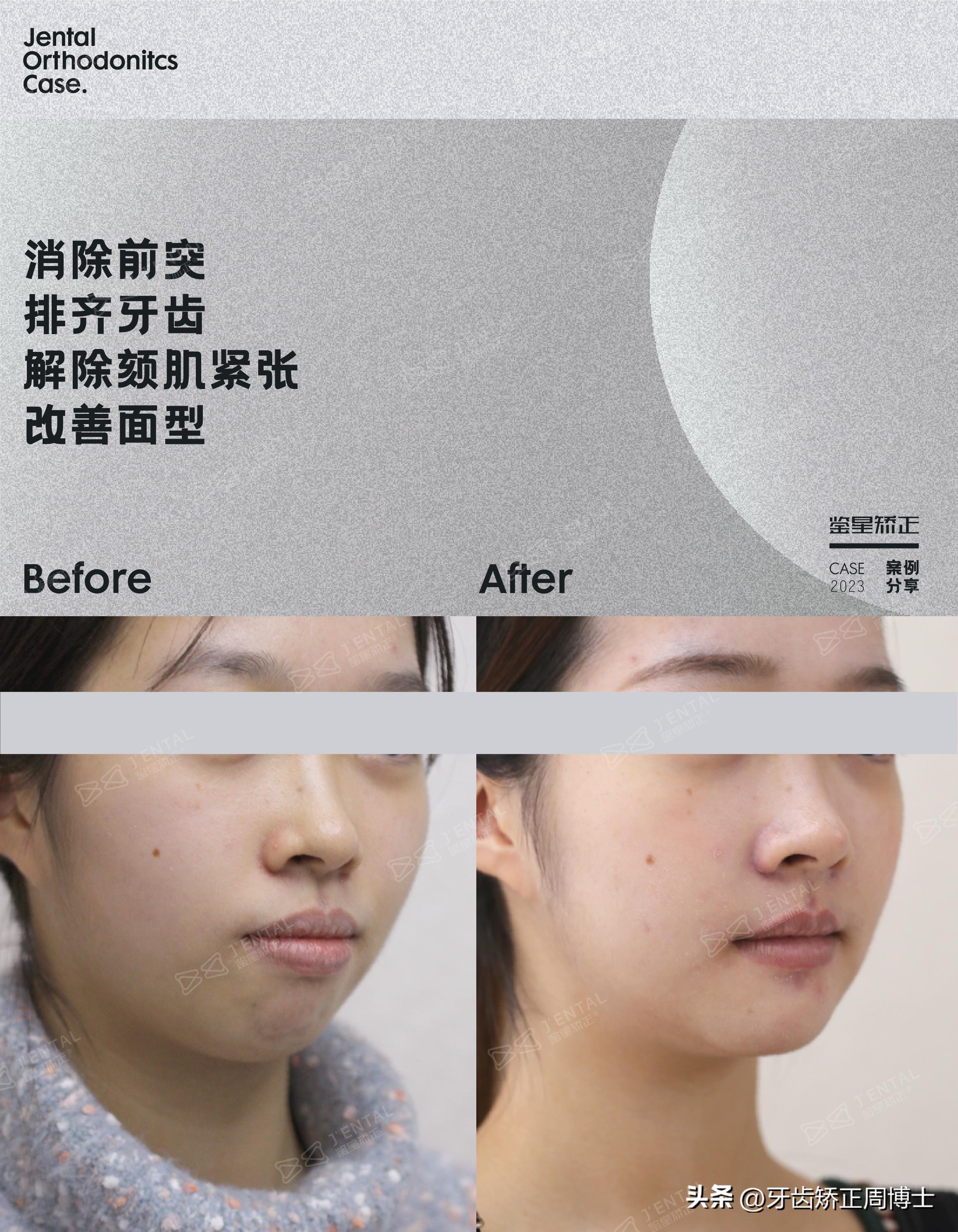 龅牙骨钉矫正演示,骨性龅牙打骨钉前后对比