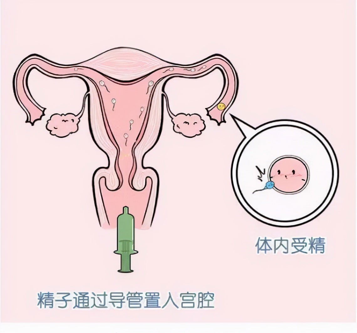 人工授精专用针管,英国妇女试管婴儿