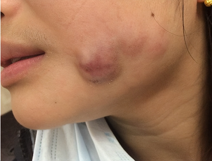 注射完后针眼溃烂怎么办,注射后针孔发炎怎么处理