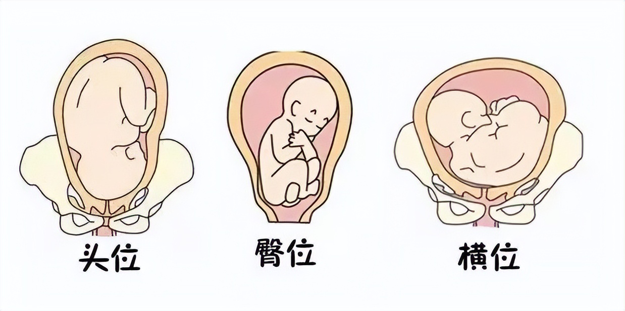 双胞胎顺产最佳胎位,怀孕二胎胎位