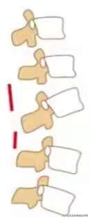 神经根颈椎病的症状和治疗方法,椎动脉颈椎病的症状和治疗方法