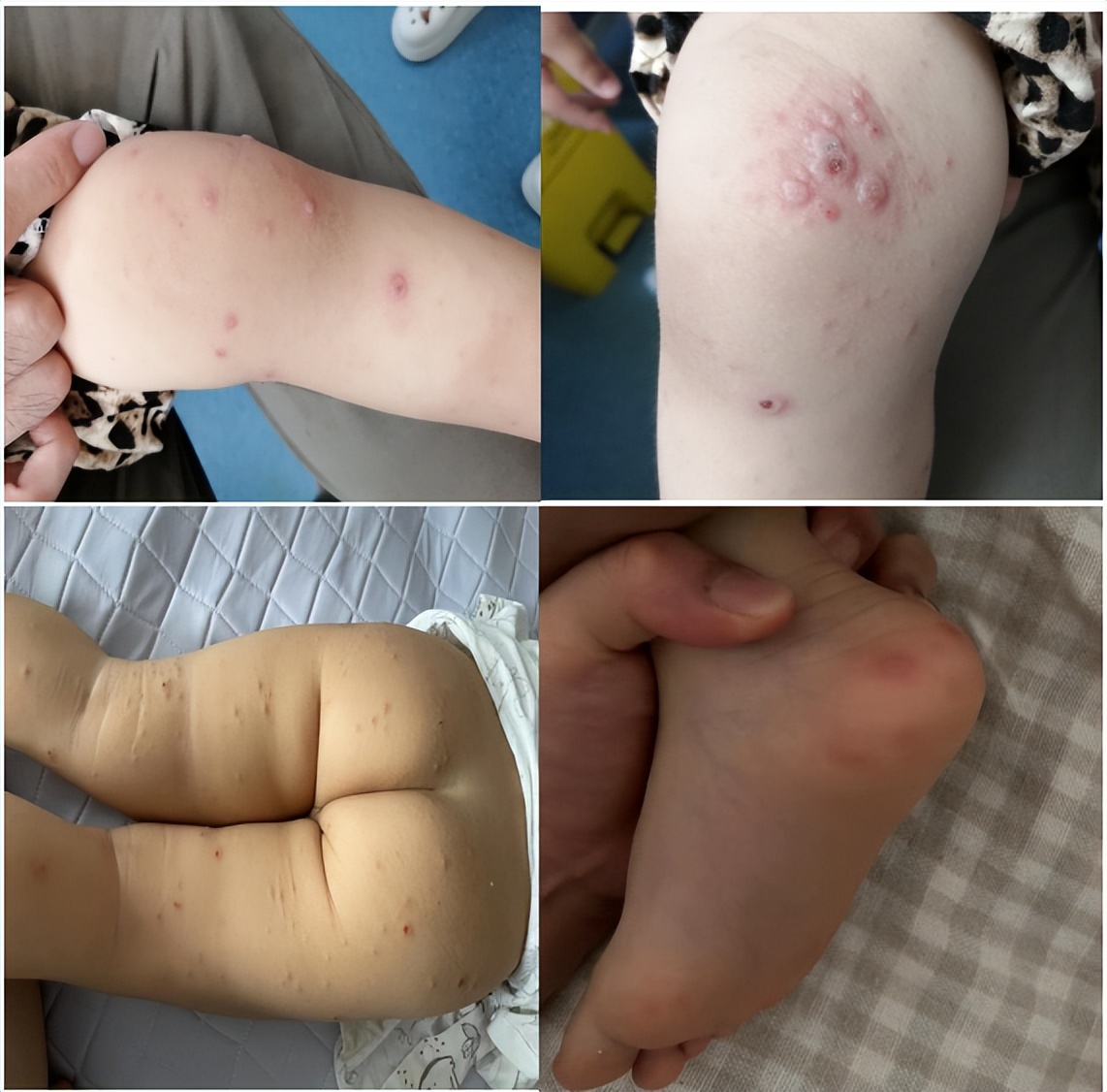 一图读懂手足口病的科普与防护,一医健康科普汇总