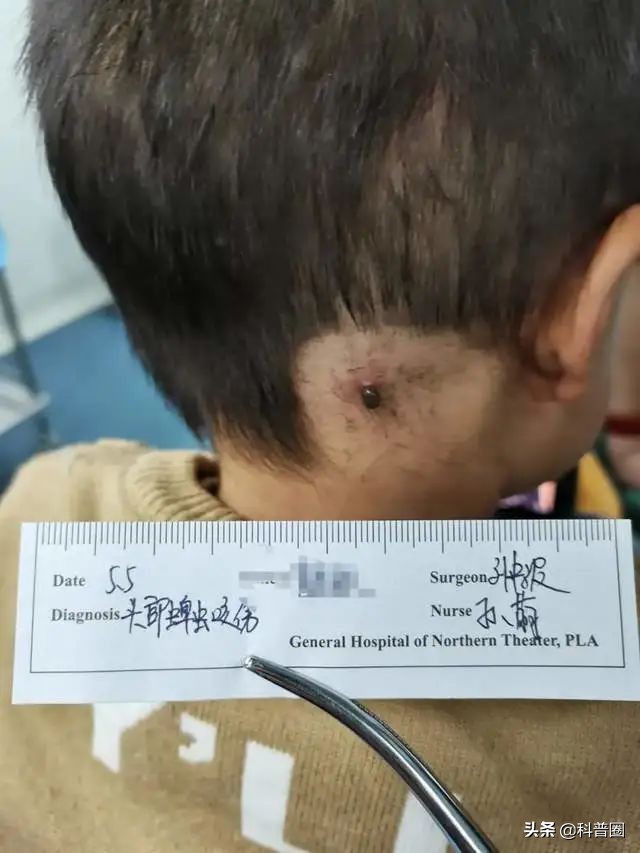 致命蜱虫,比蜱虫还可怕