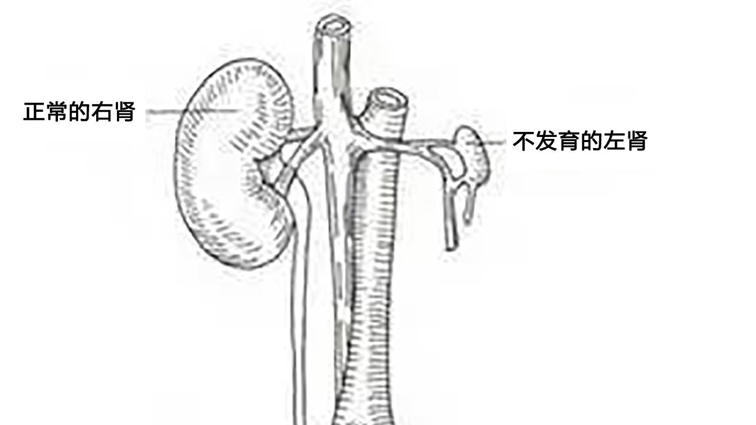 女子检查身体发现自己有两个子宫,女子查出有两个子宫