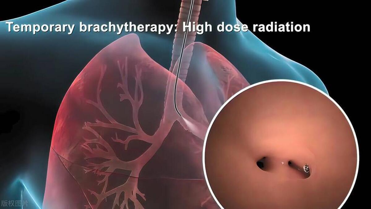 老公肺癌晚期，前天亲吻时，我突然嘴里咸咸的，老公吐痰了？