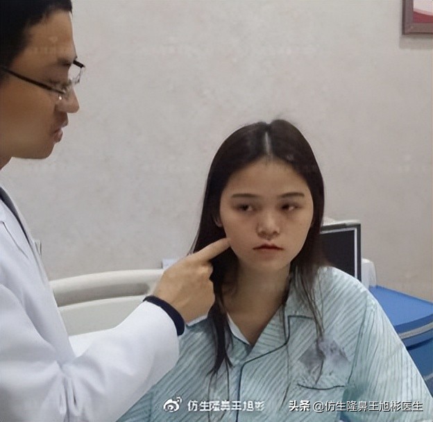 短鼻蒜头鼻整形,短鼻延长术切口