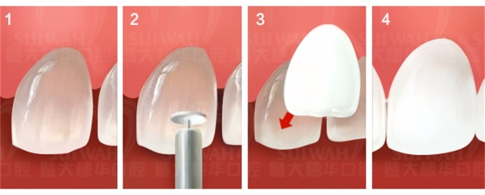 暨大穗华口腔种植一颗牙多少钱,暨大穗华口腔1980种牙靠谱吗