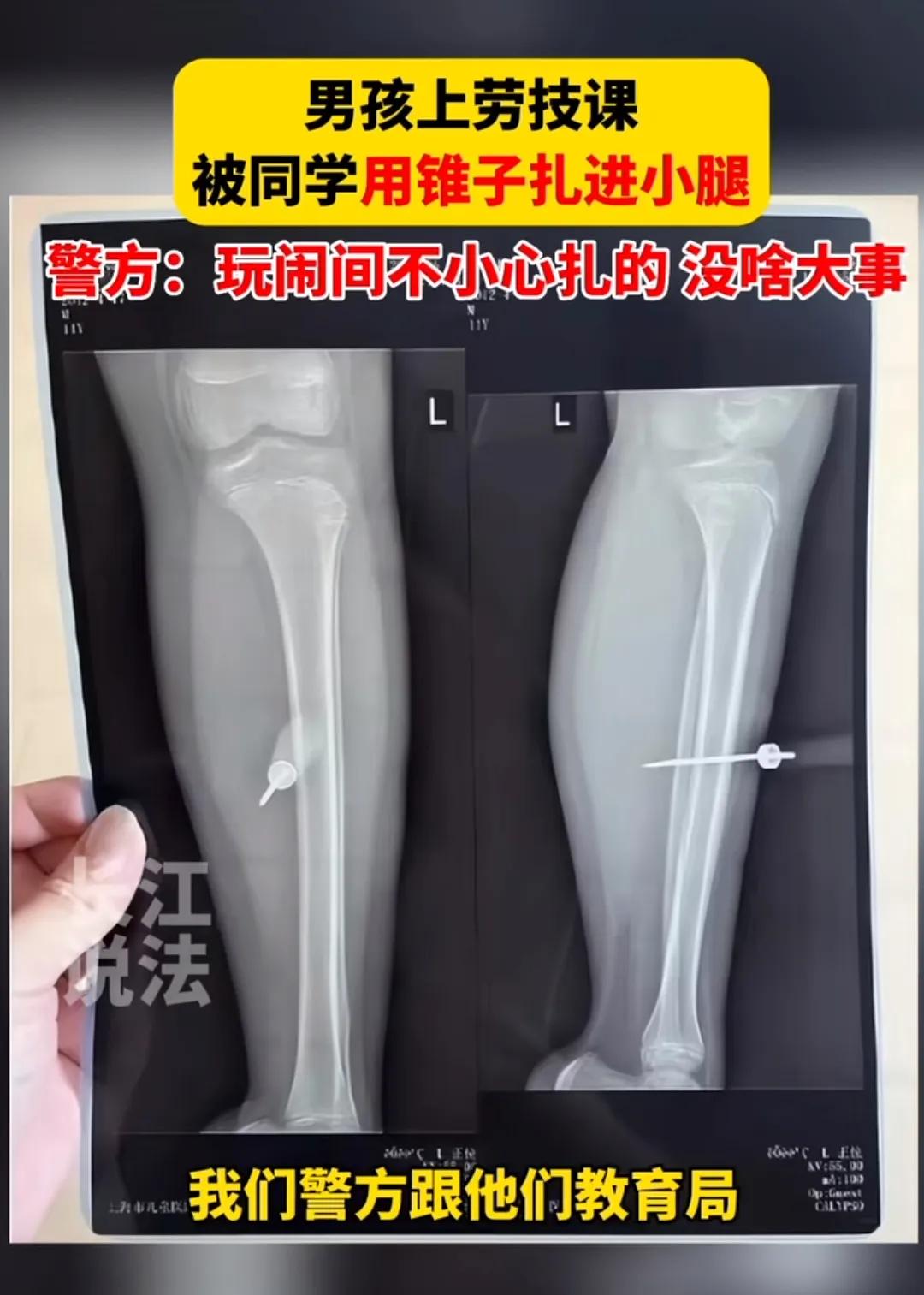 小学生被铁锥扎进小腿,上海小学生被铁锥扎腿