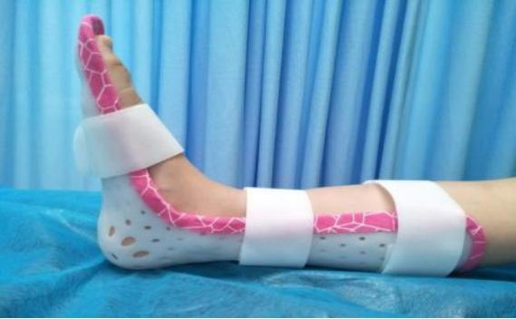 足踝骨折康复,足踝骨折康复训练视频