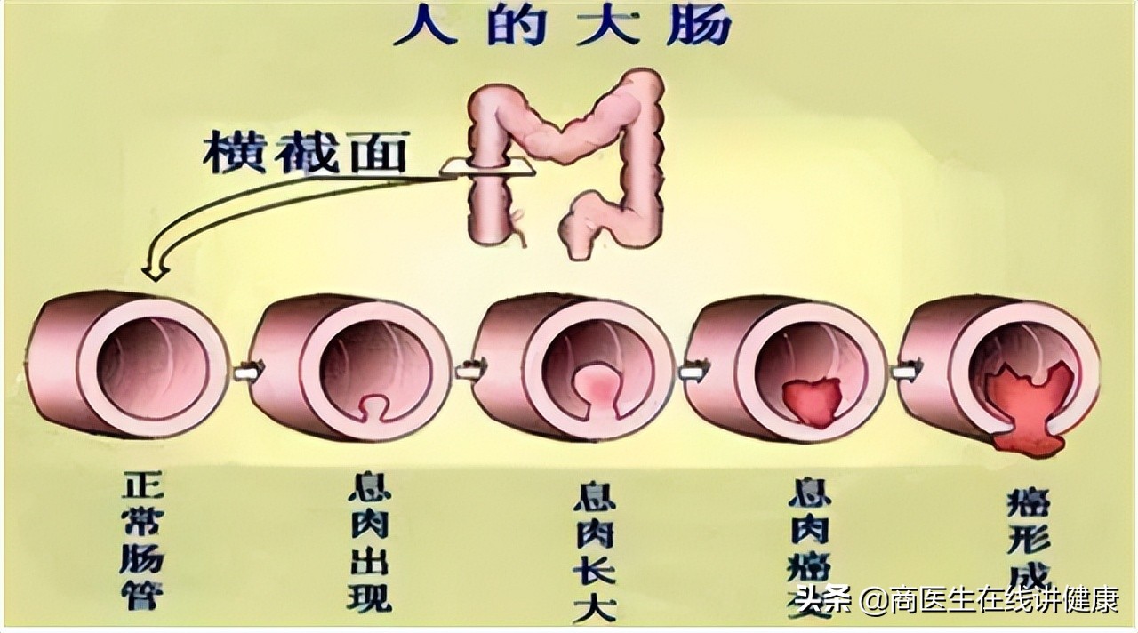 为什么会有肠道息肉,为什么肠道会长息肉
