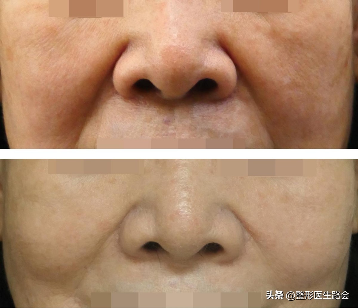 鼻基底填充法令纹瞬间消失,鼻基底填充后法令纹能改善多少