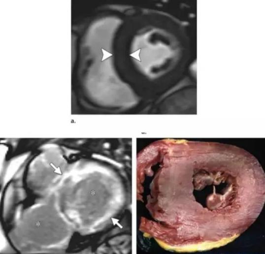 85岁老人下肢水肿是什么原因,92岁老人心衰引起脚水肿没事吧