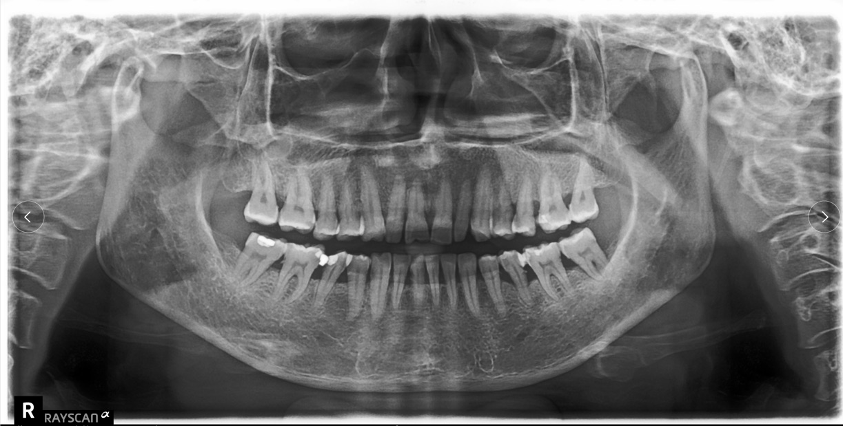 二手牙科全景机出售,二手口腔全景机邯郸