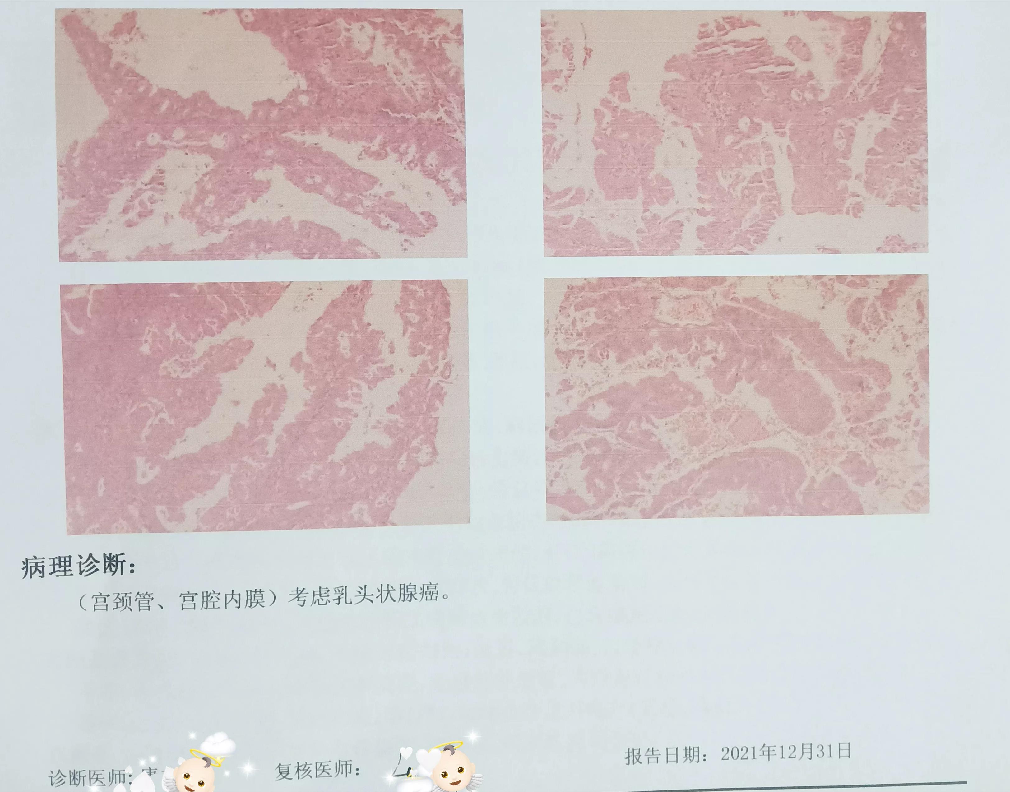 26岁女子子宫癌,56岁女性出血疑似子宫癌