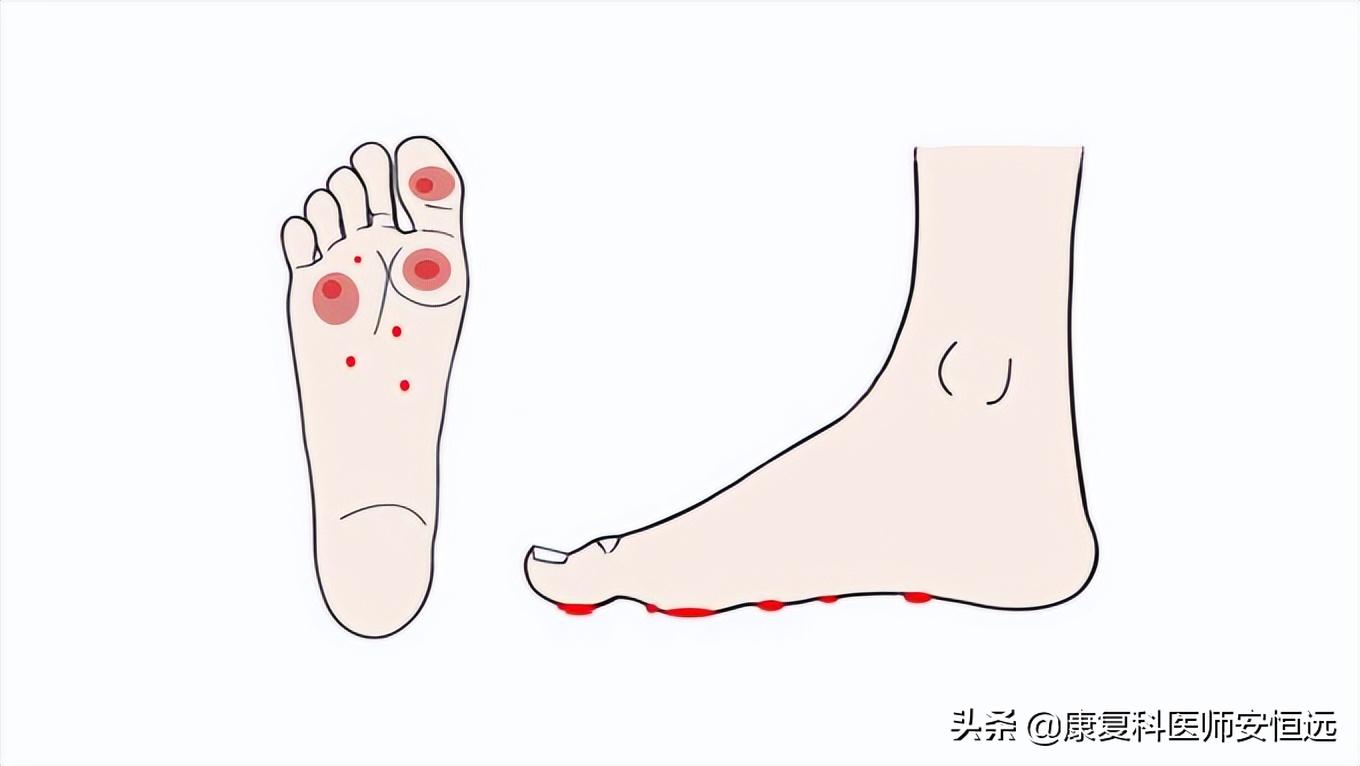 脚底板前面长茧子很疼怎么治疗,脚底板长很厚茧子疼怎么去除