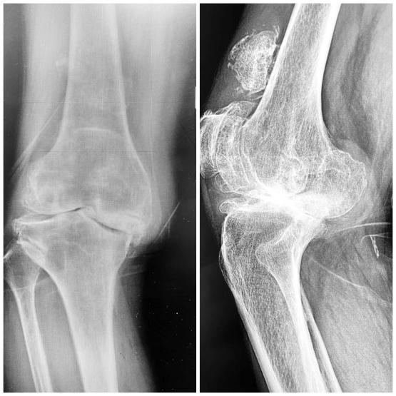 【学*党**史办实事】兰大二院西固医院骨科开展首例导航（IKPAS）下膝关节置换术（TKA）