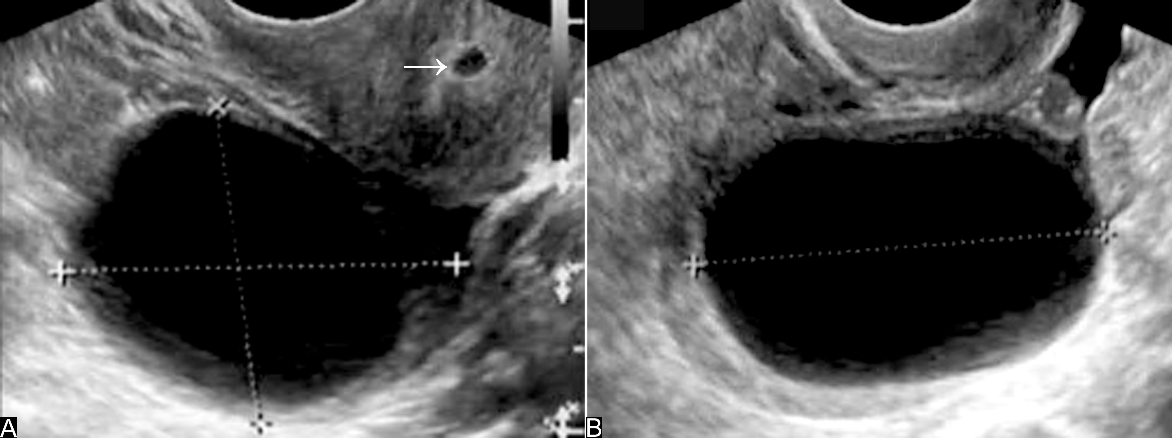 怀孕检查卵巢肿瘤良性恶性几率,妊娠合并卵巢肿瘤的鉴别诊断