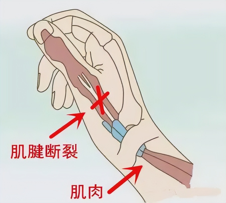 新娘新婚被夹断手指,新娘出嫁被车撞截肢