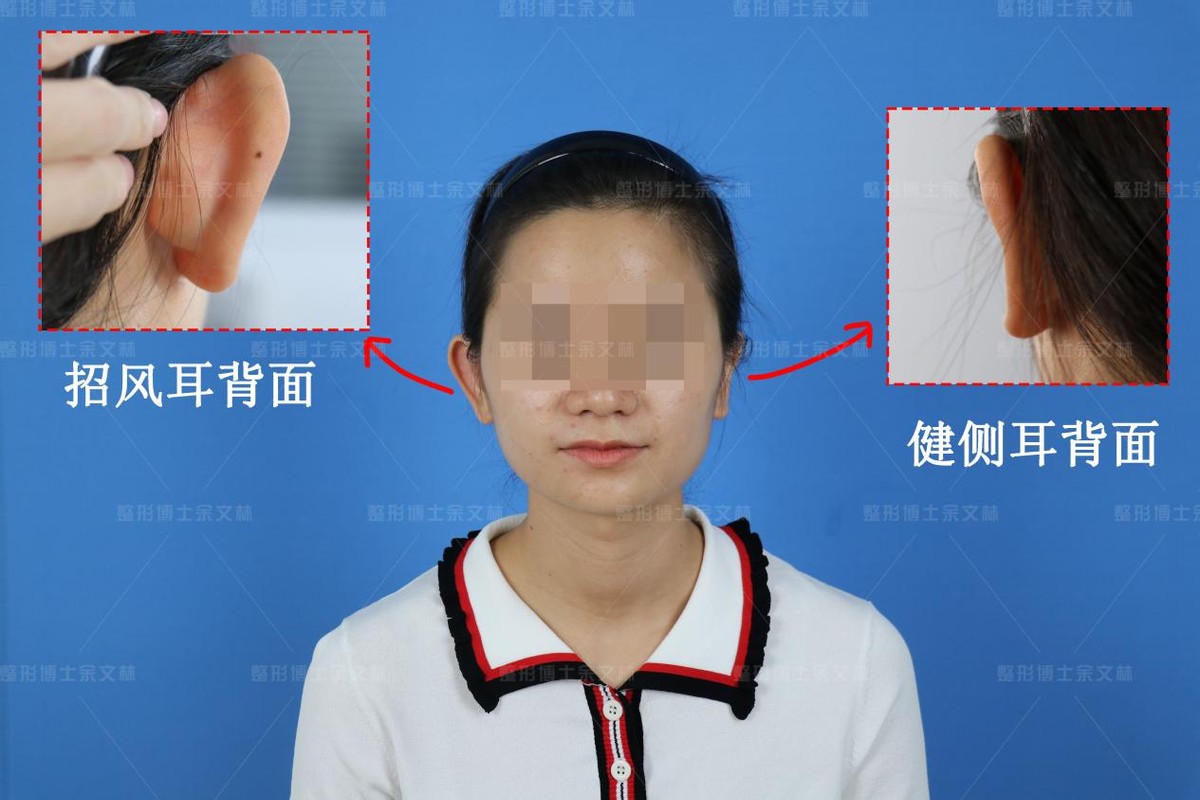 招风耳能整成正常耳朵吗,单侧招风耳有什么影响