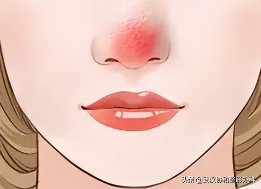 酒糟鼻导致鼻子肥大怎么办,酒糟鼻鼻子变大变厚怎么治疗