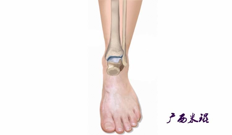 距骨软骨损伤最好的治疗方法,距骨软骨损伤的诊断