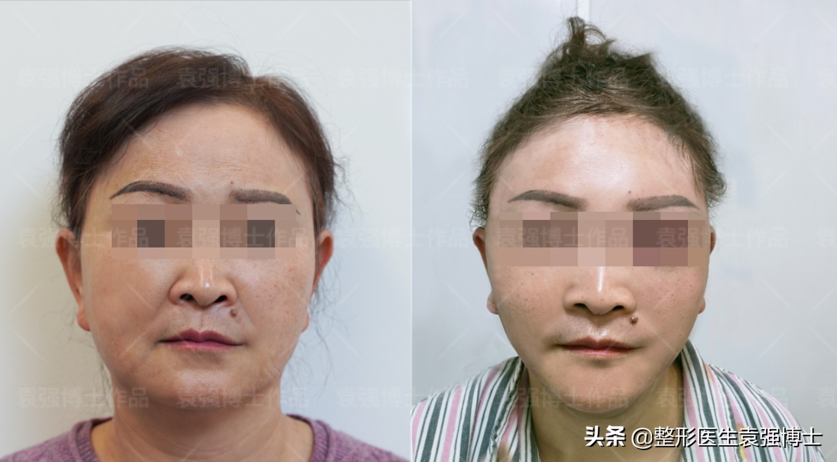 40岁面部皮肤松弛怎么紧致,40岁脸部松弛锻炼可以改善吗