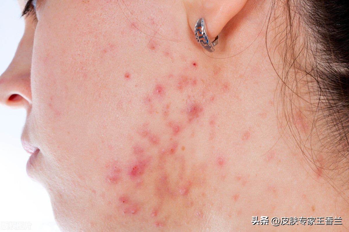 换季痘肌皮肤会出现哪些问题,换季油痘肌长痘屏障受损怎么办