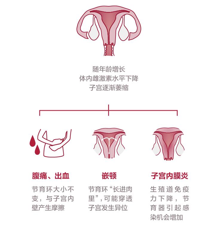 10年节育环取出时变形变色,腹部b超会提示节育环移位吗