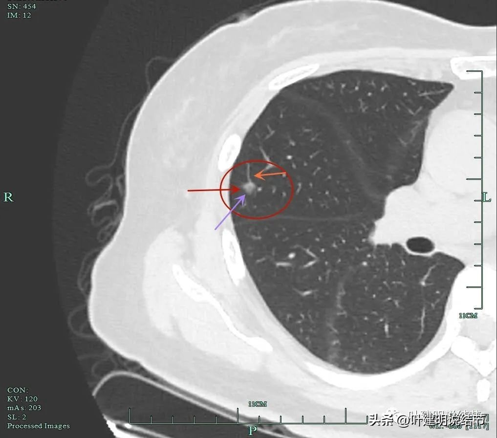 肺癌右中上叶全切,右肺上叶小结节查出是癌怎么办