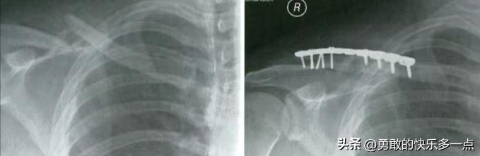 锁骨骨折错位不治疗会怎样,锁骨骨折处理