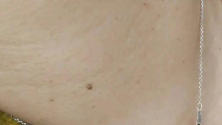 hpv病毒引起的疣是什么,hpv引起的病毒疣