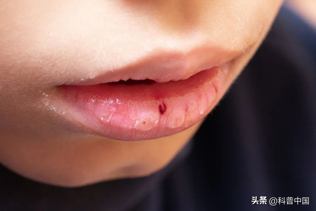 嘴唇越舔越干是什么原因,嘴唇起皮了用舌头舔嘴唇