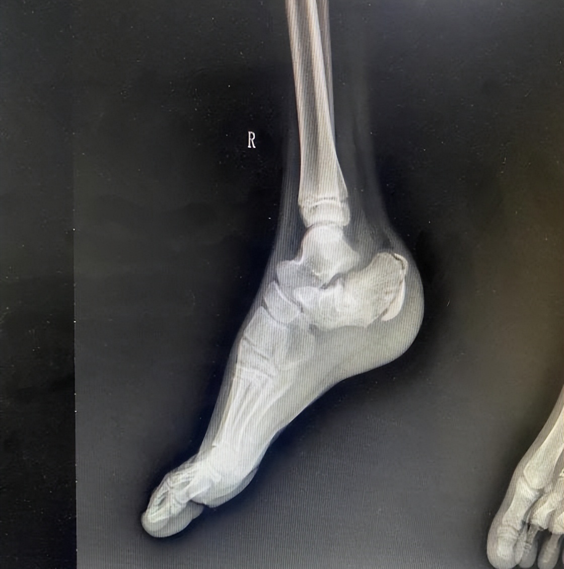 跗骨窦手术能治好吗,跗骨窦入路治疗跟骨骨折适应症