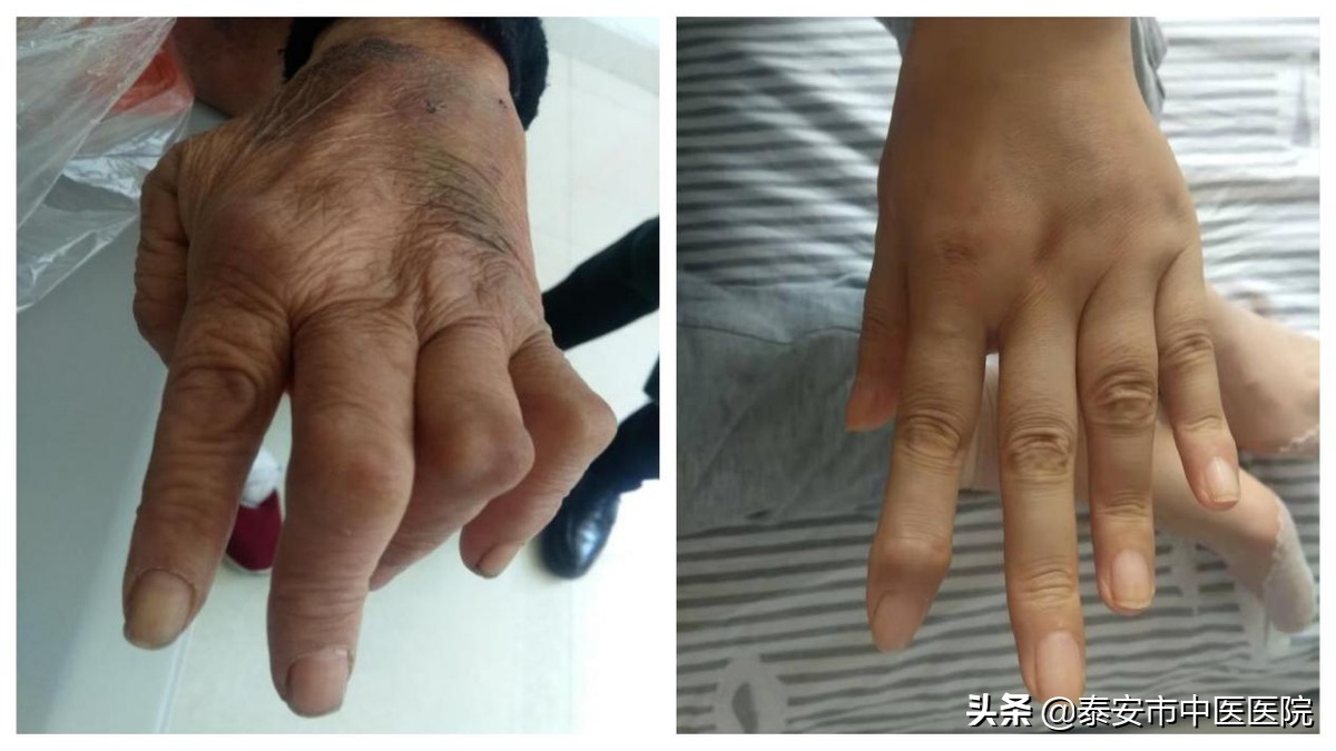 治疗风湿病的中成药有哪些,治疗风湿病的中医理疗