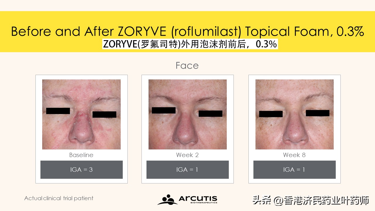 可快速清除疾病并显著减少瘙痒！Zoryve泡沫剂获准用于脂溢性皮炎