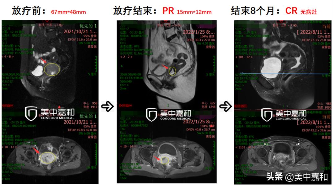局部癌症,癌症晚期的奇迹案例
