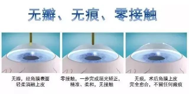 近视眼征兵体检流程,南阳市南石眼科医院检查近视费用