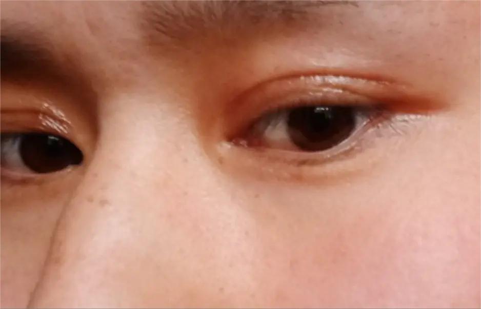 双眼皮手术后眼睛淤紫怎么消除,双眼皮术后眼头紧绷有细纹